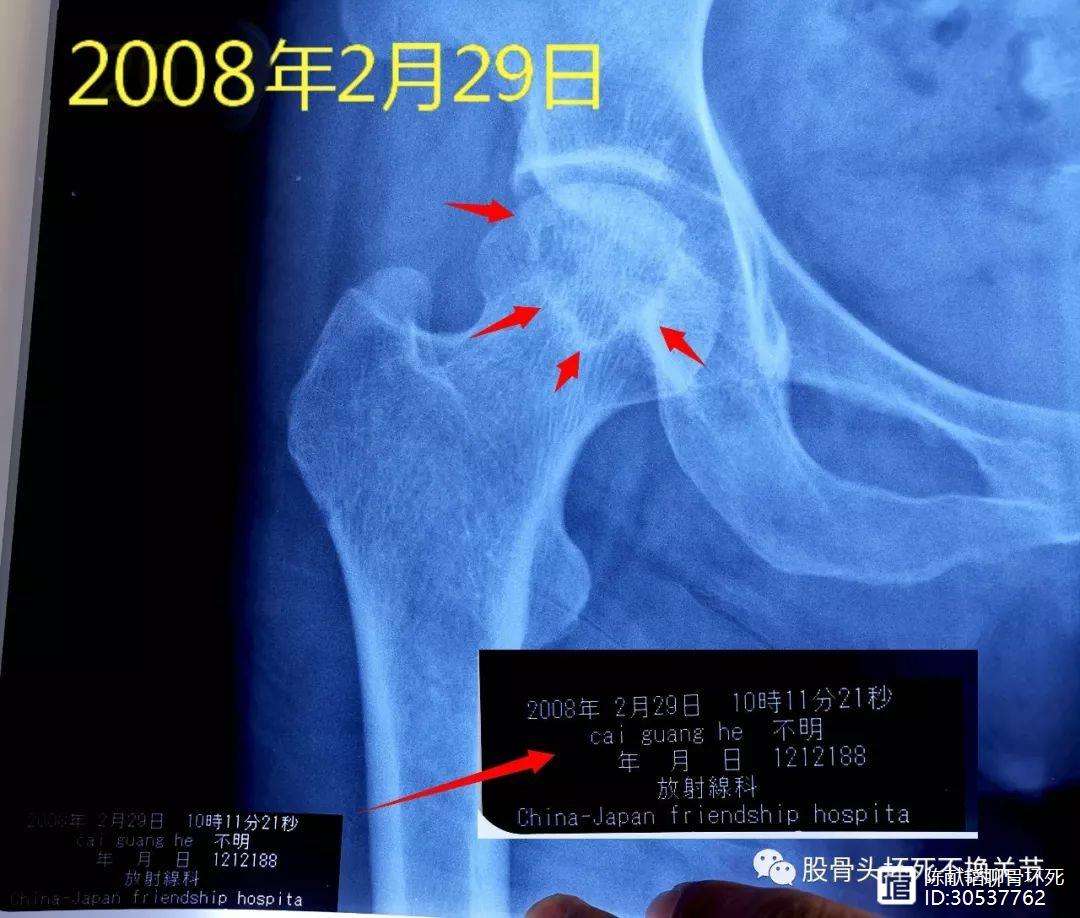 汕尾人工骨头医保报销多少(人工骨头医保报销多少比例)